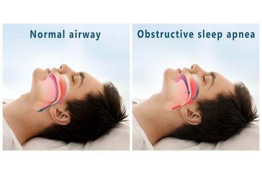 Why Addressing Snoring Early Can Save Your Health