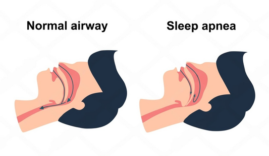 The Connection Between Snoring and Sleep Apnea: What You Need to Know