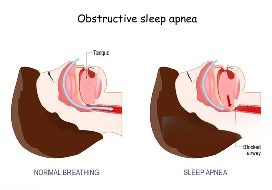 The Science Behind Snoring: Why It Happens and How to Prevent It