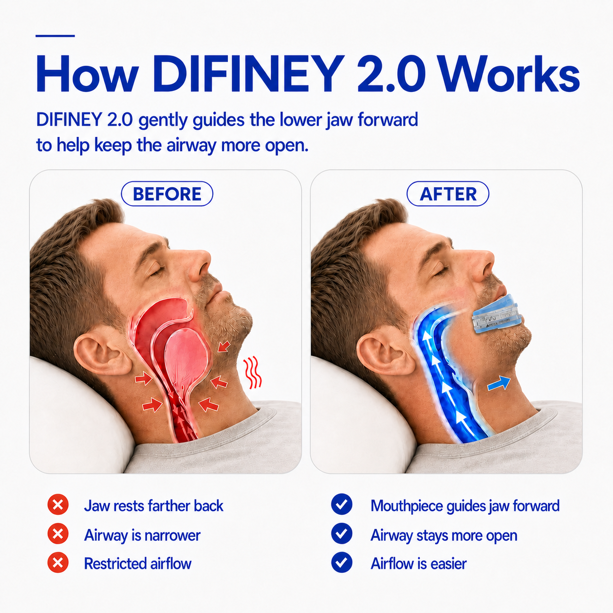 Anti Snoring Device 2.0 airflow and fit mechanism explained