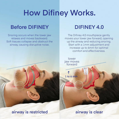 Difiney Advanced Anti Snoring Mouthpiece Device 4.0 - Customizable Adjustable Comfortable - Patent Pending Design